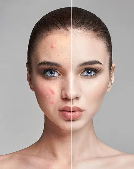 Vampire Facial