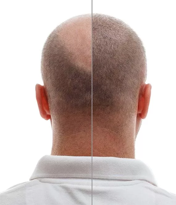 PRP hair treatment Melbourne