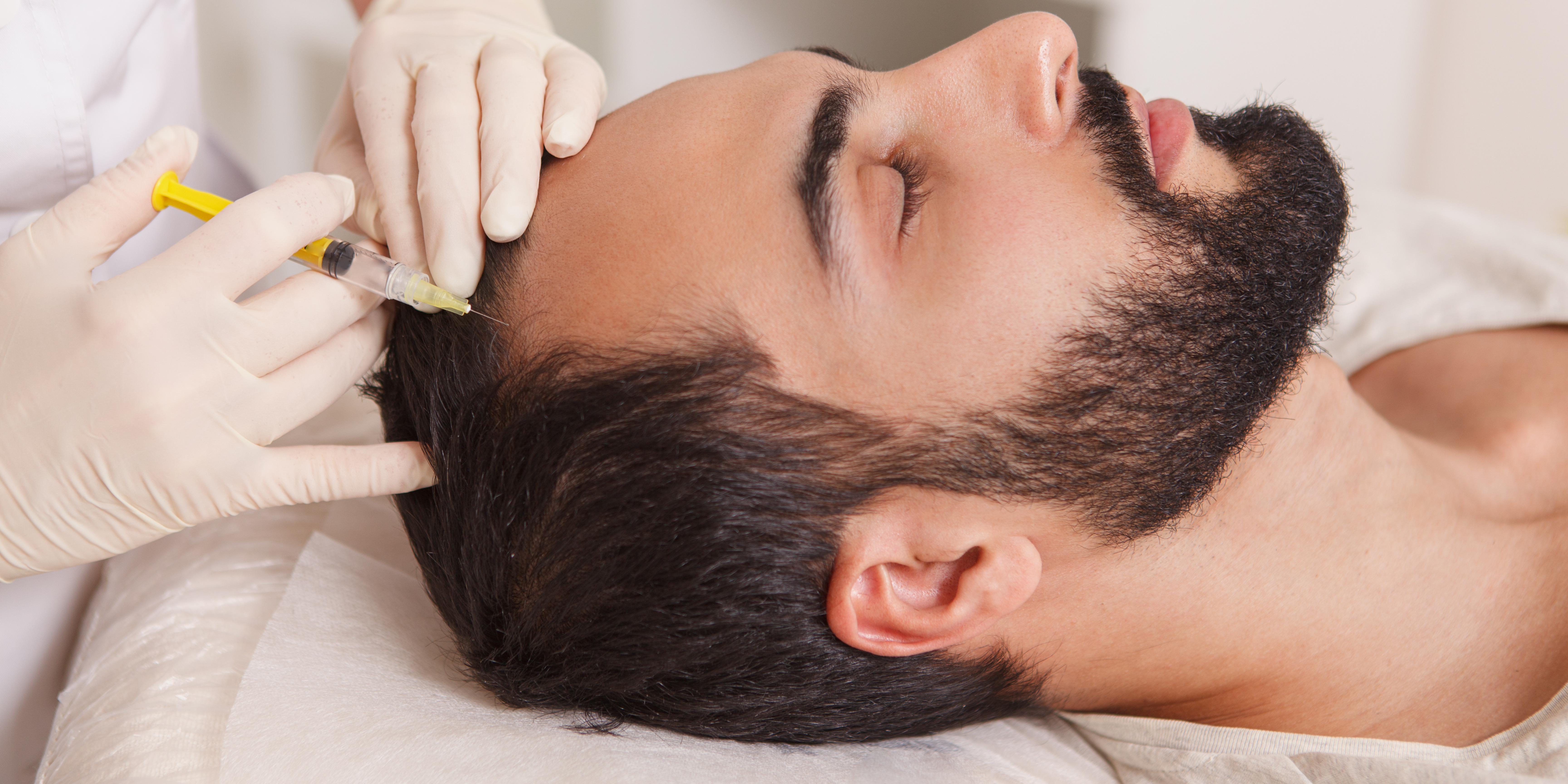 PRP hair loss