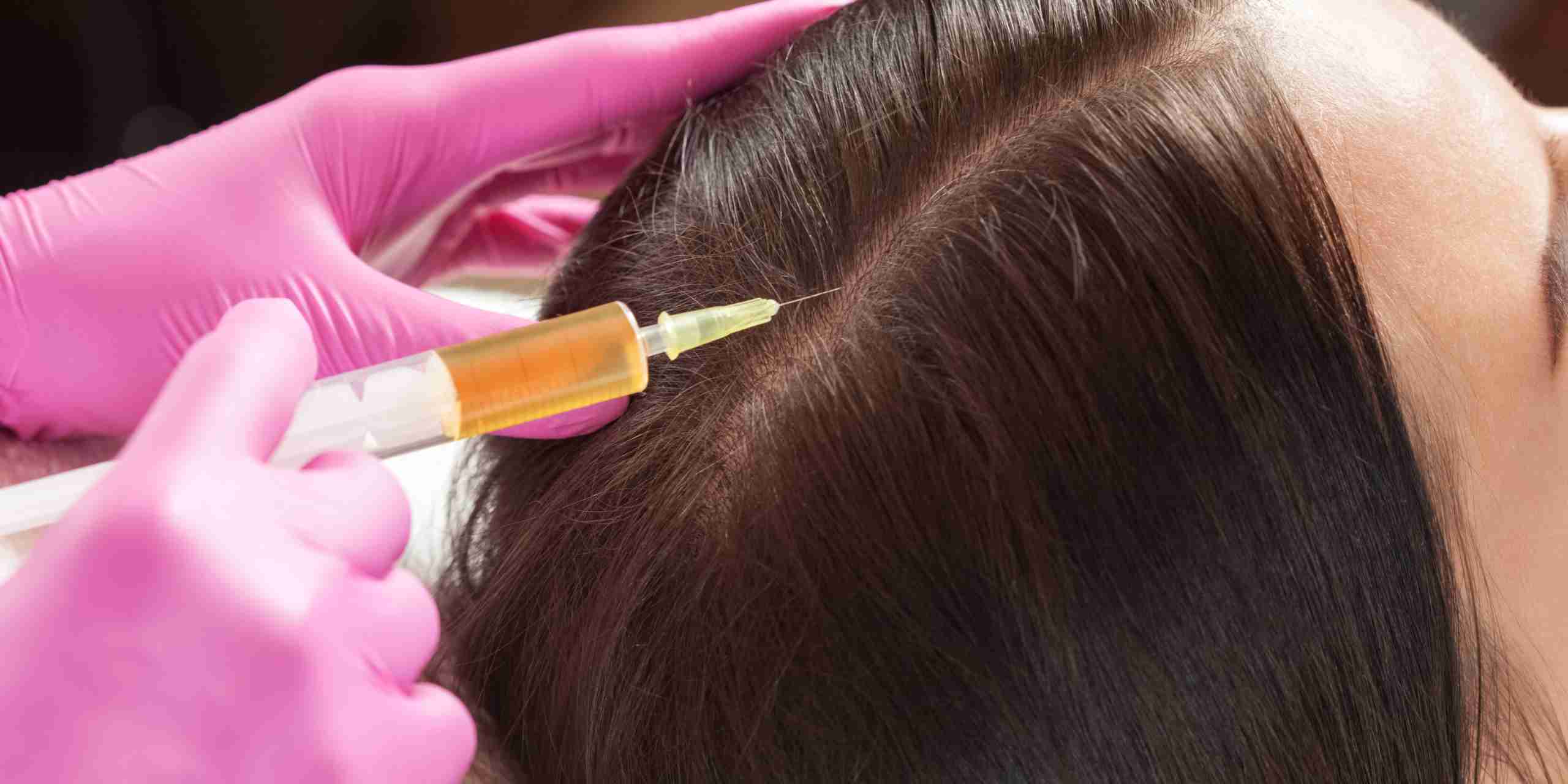 prp for hair loss