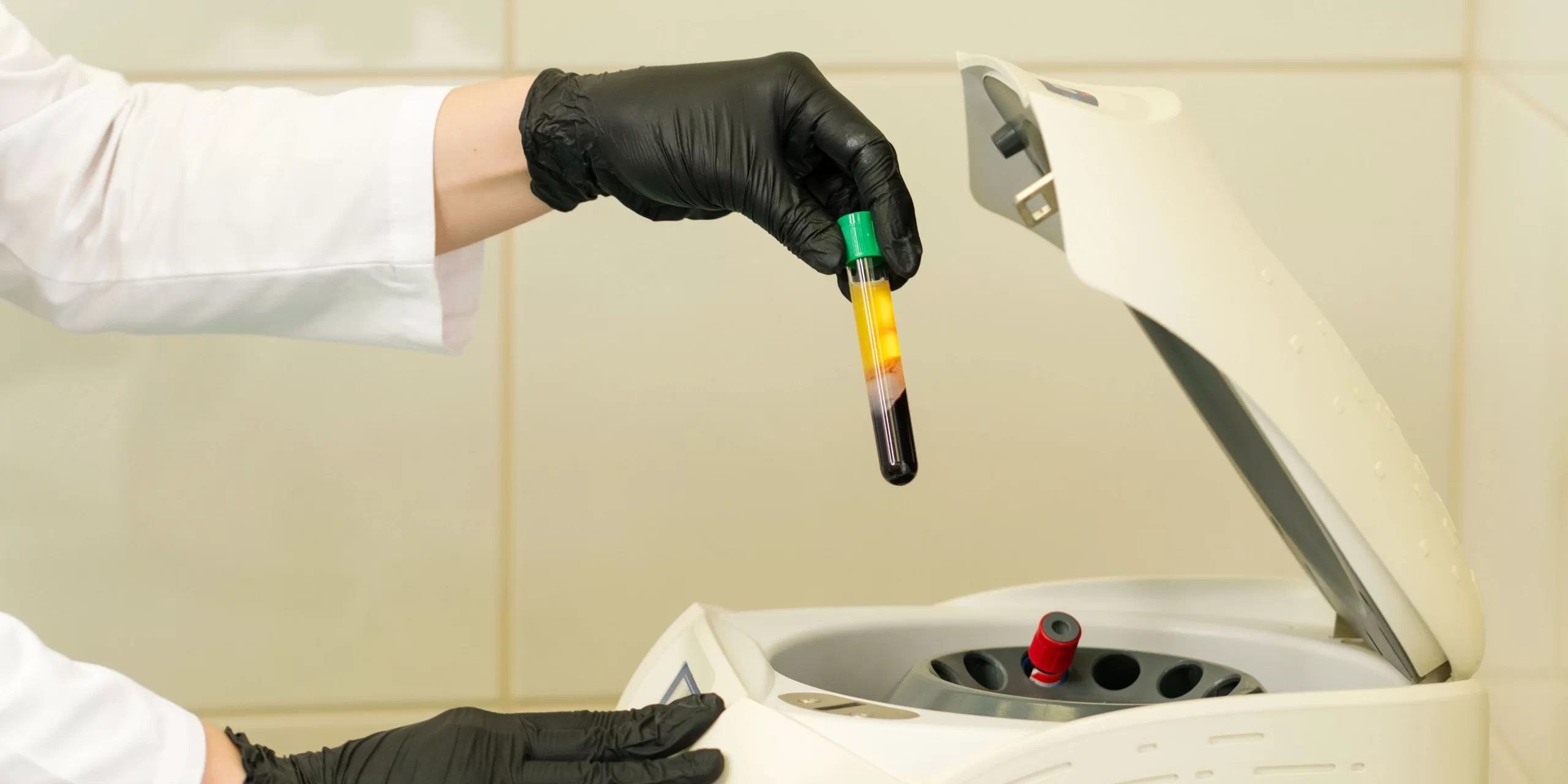 Is PRP (Platelet-Rich Plasma) useful for treating hair loss?