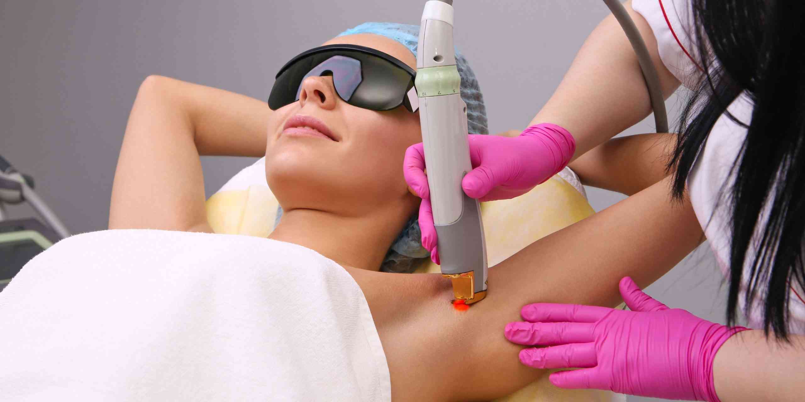 laser hair removal