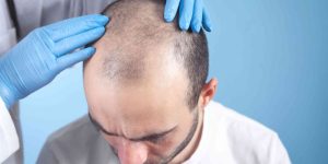 prp hair regrowth