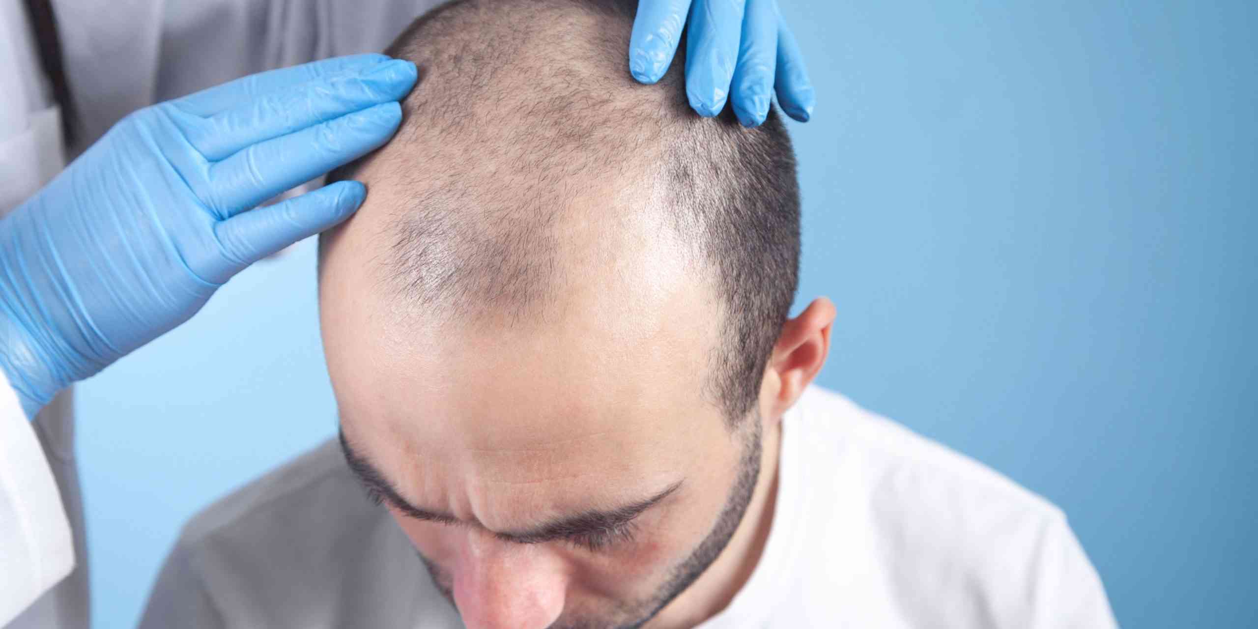 prp hair regrowth