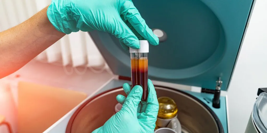 The Impact of Platelet-Rich Plasma on Hair Regrowth